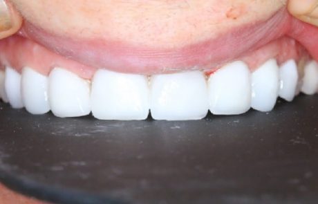 זה הזמן להתייעץ עם רופא שיניים על טיפולי הלבנה