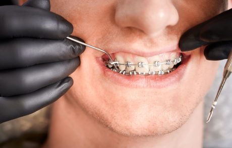 יישור שיניים: אפשרי גם למבוגרים?