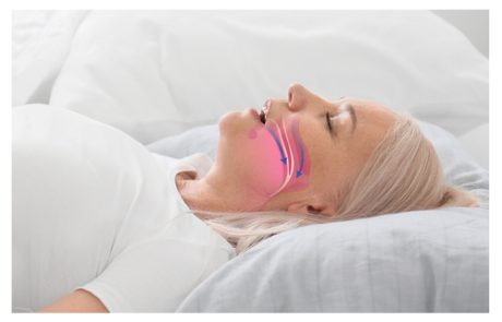 מניעת דום נשימה בשינה: תפקידם של מכשירי ומסכות של Cpap